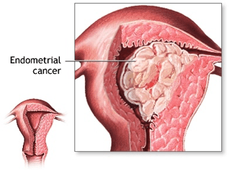 Endometrial cancer mirena