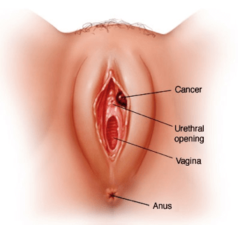 Vulval Cancer - Supratik