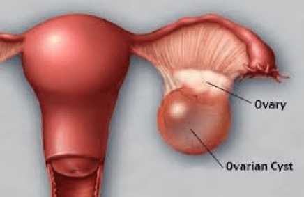 OVARIAN CYSTS - Supratik